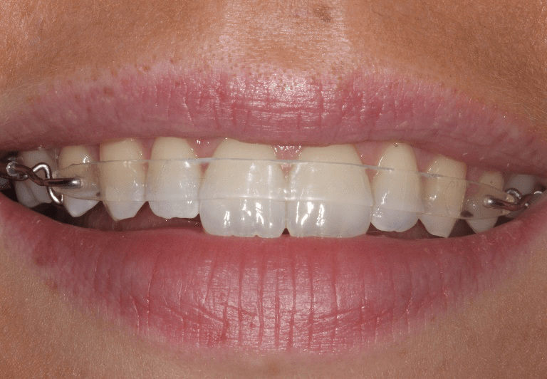 clearsmile braces